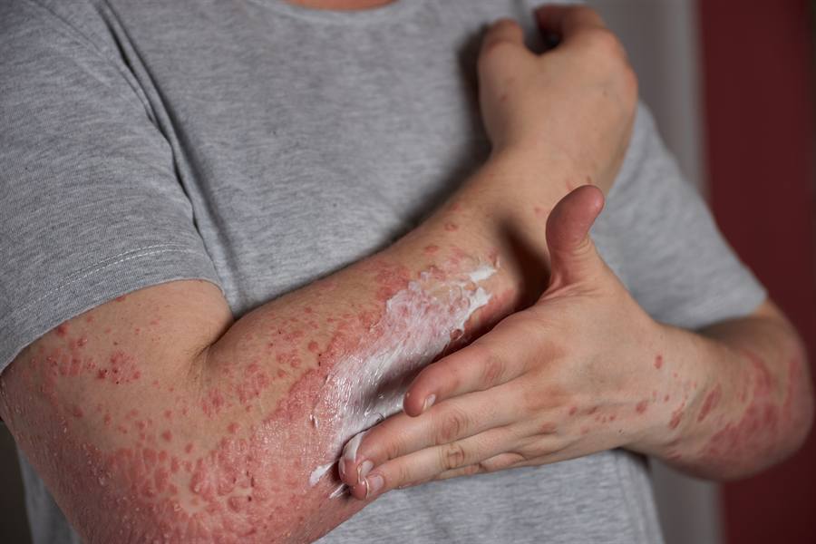 Skin and Allergic Conditions